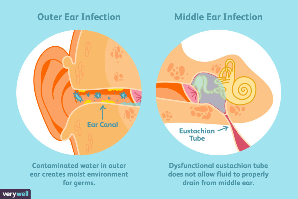 Types of Ear Infections in Children