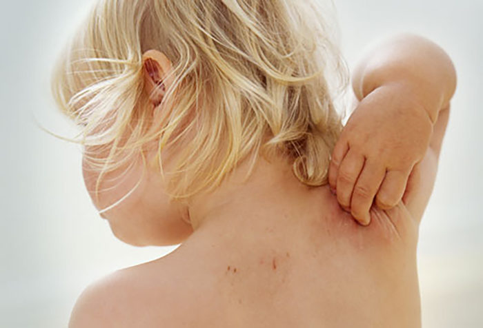 Skin Rashes in Children