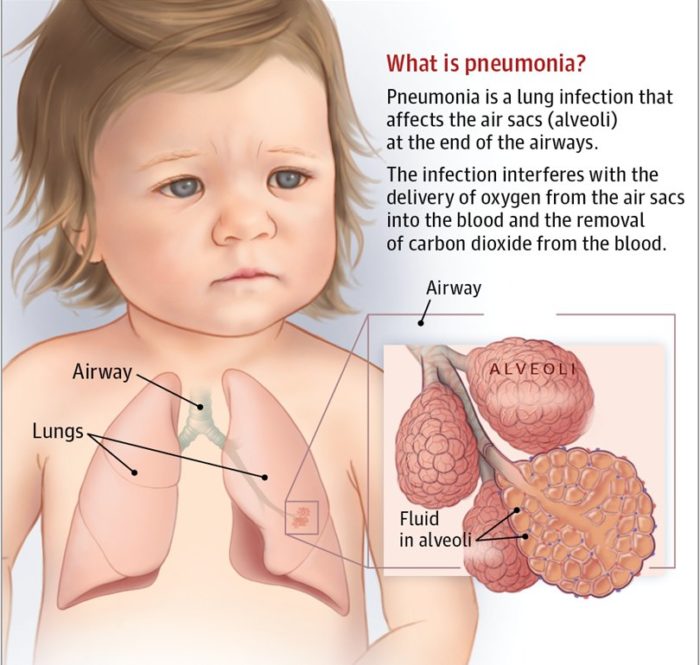 Risk Factors of Childhood Pneumonia