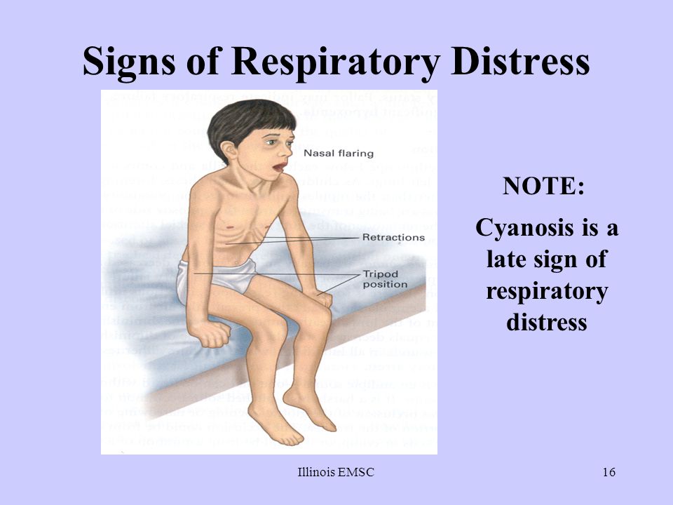 Respiratory Distress in Children