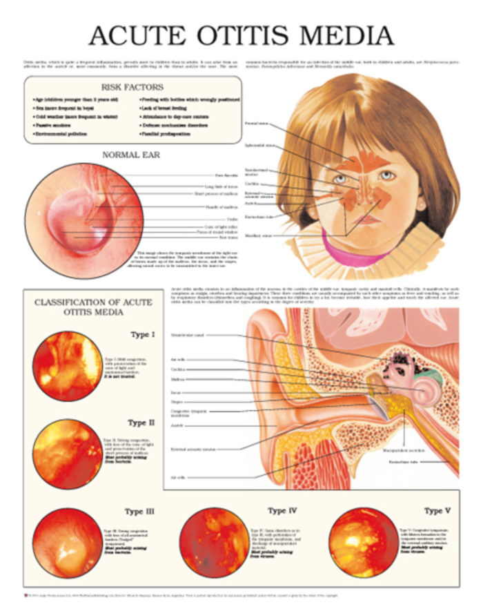 Risk Factors for Otitis Media in Young Ones