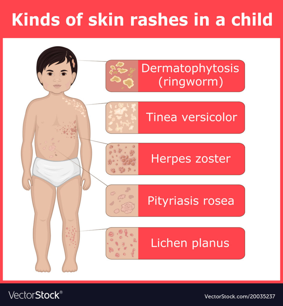 Different Types of Skin Rashes in Children