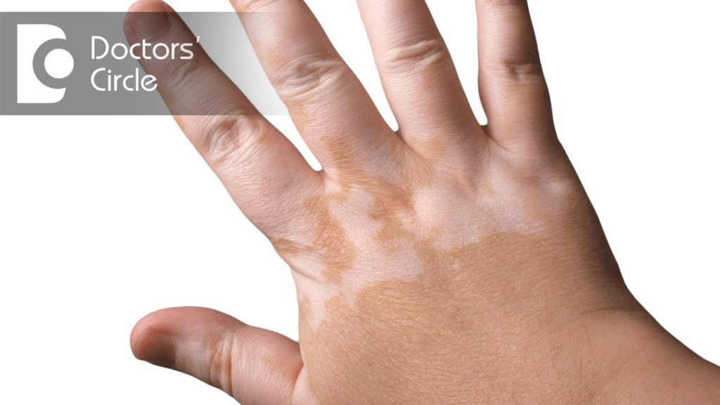 Common Causes of Skin Discoloration