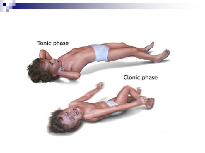 Types of Seizures or convulsions in Children